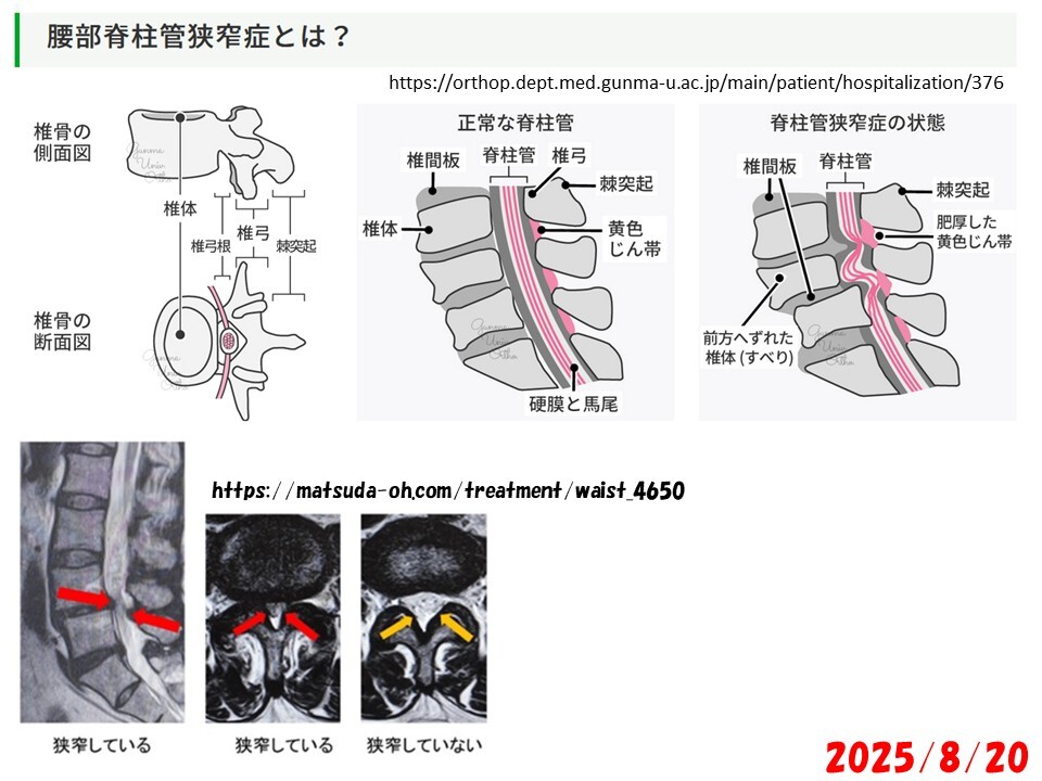 250820_脊柱管狭窄症_01